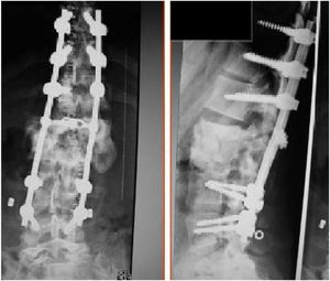 Postoperative X-Ray: T10-L4 arthrodesis and L1–L2 consolidation.