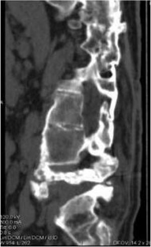 CT scan: persistence of the lesion, with no signs of progression.