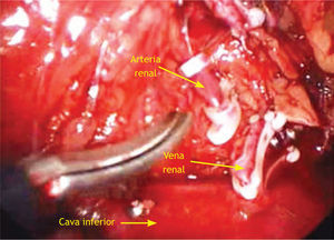 Visión laparoscópica de una nefrectomía simple derecha. Se observa vena renal ya seccionada, previa colocación de 2 Hem-o-lok® proximales, arteria renal a punto de ser seccionada. Los instrumentos laparoscópicos están cruzados. La tijera laparoscópica está siendo manejada con la mano diestra del cirujano; la mano siniestra, utiliza una pinza Grasper para rechazar cefálicamente el hígado.