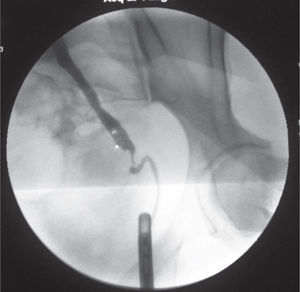 Pielografía anterógrada y retrógrada simultánea, donde se observa fístula ureterovaginal izquierda acompañada de segmento estenóstico de 1.4cm aproximadamente.