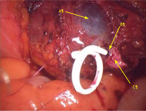 Visión laparoscópica de vejiga y uréter en el momento de realizar la ureteroneocistostomía. A) Mucosa vesical. B) Sutura de vértice posterior mucosa-mucosa. C) Uréter espatulado.