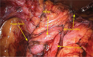 Visión laparoscópica psoas Hitch, y detrusorrafia de la ureteroneocistostomía.