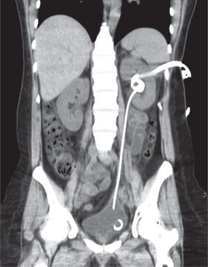 Urotomografía simple corte coronal, se aprecia psoas Hitch, catéter doble J y nefrostomía.