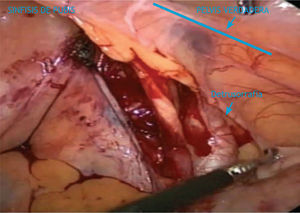 Disección de vasos ilíacos. Se incide peritoneo disecando cuidadosamente la arteria y vena ilíaca externa.