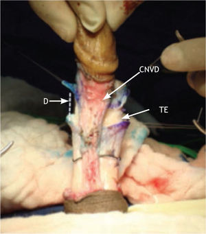 Apariencia rectangular del defecto (D) generado por una sola incisión sobre la túnica sobre el punto de curvatura mayor (PCM) previamente marcado, dejando expuesto el tejido eréctil (TE), respetando el complejo neurovascular (CNV).