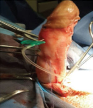 Se estimula corrección dorsal con 2 pinzas Allis sobre el punto de curvatura mayor (PCM), previo a colocación de sutura para plicatura.