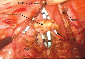 Resección de trayecto fistuloso. Se observa fístula ya circuncidada sobre catéter ureteral. En el fondo la vagina conteniendo gasas empaquetadas.