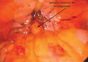 Interposición de apéndice epiplóico de recto-sigmoides entre vagina y vejiga.