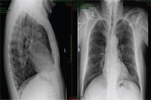 Radiografía de tórax con la presencia de múltiples imágenes radiopacas paramediastinales y desviación de la columna aérea traqueal.