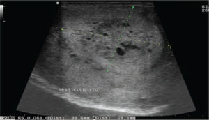 USG testicular con imagen heterogénea francamente sospechosa de malignidad
