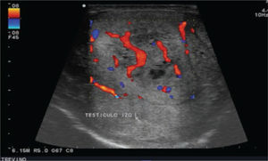 Refuerzo Doppler con aumento de vascularidad en imagen heterogénea testicular izquierda.