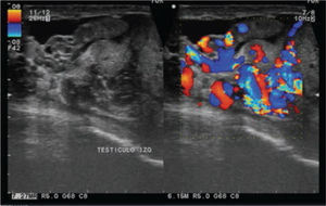 Imagen Doppler donde se observa tortuosidad y aumento evidente de la vasculatura testicular izquierda.