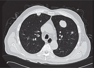 Imagen tomográfica demostrando actividad metastásica múltiple voluminosa en parénquima pulmonar.