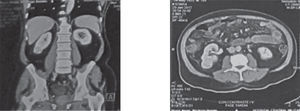Tomografía de abdomen en corte coronal y axial, que muestra un tumor renal derecho.