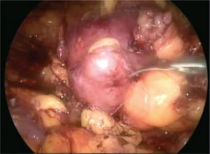 Imagen del tumor previo a la realización de ultrasonido laparoscópico de alta definición.