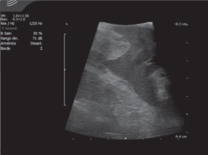 Imagen del ultrasonido laparoscópico transoperatorio para delimitar los bordes y profundidad de la resección.