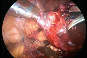 Imagen donde se muestra la resección del tumor posterior a la realización de ultrasonido laparoscópico.