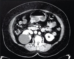 Tomografía abdominal contrastada. Se evidencia imagen hipodensa en cara dorsal de riñón derecho, sin reforzamiento con el medio de contraste.