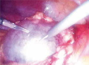 Destechamiento de quiste renal vía laparoscópica. Punción de quiste renal.