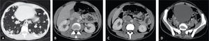 A) Múltiples metástasis pulmonares en bala de cañón. B), C) Ganglios retroperitoneales intercavoaórticos. D) Vejiga distendida correspondiente a globo vesical, asociado a la sección medular.