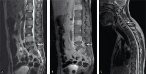 A), B) Resonancia magnética donde se observan múltiples metástasis vertebrales, principalmente T12, L4 y L5, con extensión a canal medular en L5 (flechas). C) Metástasis en columna cervical y torácica, con extensión a canal medular a nivel de C7 (flecha).