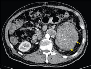 Tomografía axial computarizada, corte axial. Se identifica claramente tumor renal izquierdo (flechas).