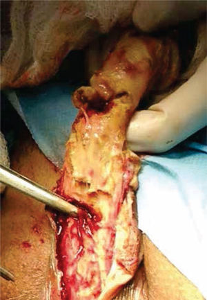 Compromiso de los tejidos y la uretra en el transquirúrgico.