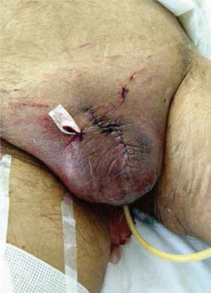 Posquirúrgico inmediato con uretrostomía perineal.