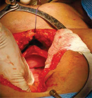 Exploración quirúrgica abdominal, donde se evidencia la ausencia de estructuras Müllerianas y de vestigios testiculares.