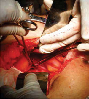 En la exploración quirúrgica se aprecia una vejiga de capacidad normal y sin próstata palpable de forma bimanual; se realiza la apertura de la cúpula en el diafragma urogenital.