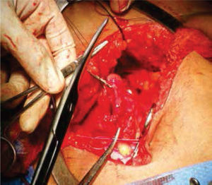 Se realiza anastomosis término-terminal del asa proximal y distal al segmento resecado.