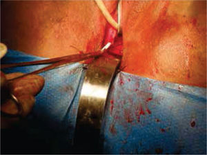 Se aboca el cabo proximal al neocanal vaginal, se anastomosa y se cierra el cabo distal en 2 planos.