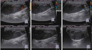 Ultrasonido testicular Doppler, donde se observa imagen heterogénea que ocupa el 70% del parénquima testicular compatible con neoplasia.