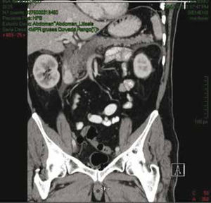 Caso 1. Tomografía axial computarizada abdominal con evidencia de pancreatitis, Balthazar E y derrame pleural derecho del 10%.