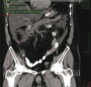 Caso 2. Tomografía axial computarizada abdominal con evidencia de pancreatitis, Balthazar E.