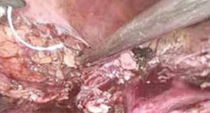 Imagen intraoperatoria durante la reparación primaria.