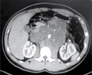 Tumor retroperitoneal que abarca desde los vasos renales. Se observa la infiltración hacia vasos ilíacos izquierdos.