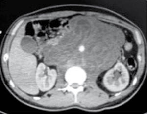 Tomografía de control posquirúrgica. Se observa la progresión tumoral gigante posterior a 4 ciclos de bleomicina, etopósido y cisplatino (BEP).