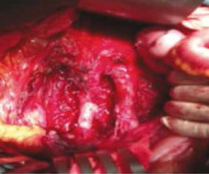 Resección retroperitoneal de tumor gigante. Se observa la aorta y la cava. Resección en bloque del tumor.