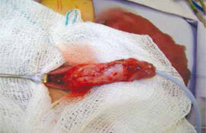 Se realiza cierre de uretra sobre sonda Foley 8Fr, con sutura PDSTM 6-0 en 2 planos, se coloca parche de fascia subdérmica.