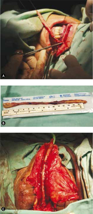A) Toma del injerto en una sola pieza. B) Injerto de mucosa oral mayor a 15cm. C) Colocación del injerto sobre una sonda Foley 16Fr de tipo Silastic®.