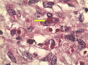 La malacoplaquia es una lesión inflamatoria crónica que puede producir destructivas masas nodulares, las cuales pueden confundirse con neoplasia como se ilustra en esta figura (flecha amarilla). El nódulo se compone de histiocitos con elementos inflamatorios mezclados. La respuesta inflamatoria, en particular, la infección por bacterias Gram negativas, más frecuentemente Escherichia coli, puede resultar en malacoplaquia. La sustitución del parénquima renal por el infiltrado inflamatorio nodular es evidente (ácido peryódico de Schiff, 100x, magnificación original).