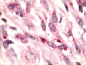 Imagen microscópica, se aprecian histiocitos de citoplasma aumentado y voluminoso con presencia de cuerpo de Michaelis-Gutmann en su interior (40x).
