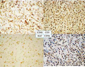 Inmunohistoquímica positiva para CD45, CD3, CD56 con Ki67 del 40 %.