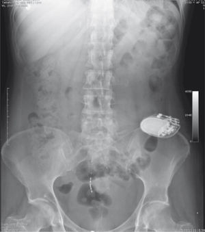 Radiografía simple de abdomen que evidencia la adecuada colocación del implante.