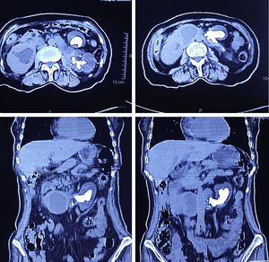 La tomografía simple de abdomen muestra hidronefrosis de predominio izquierda con lito coraliforme y disminución del parénquima renal, además de estenosis de la unión ureteropiélica bilateral.