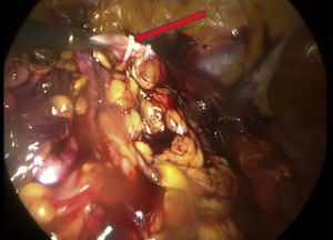 Se muestra uréter clipado y disecado en dirección cefálica hacia la pelvis renal.