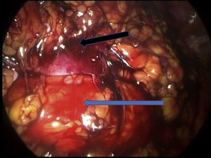 . Identificación de istmo renal (flecha negra), con la vena cava anterior (flecha azul) y la aorta en la cara posterior.