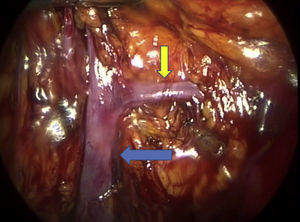 Identificación de la vena renal (flecha azul) con una rama que drena el istmo (flecha amarilla).