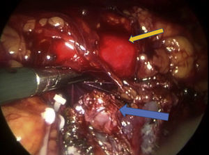 Istmo ya seccionado (flecha azul) sin evidencia de sangrado, aorta en la parte posterior (flecha amarilla).